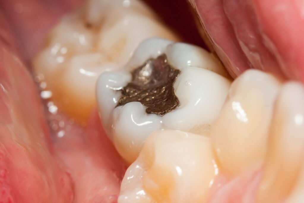 amalgam on teeth