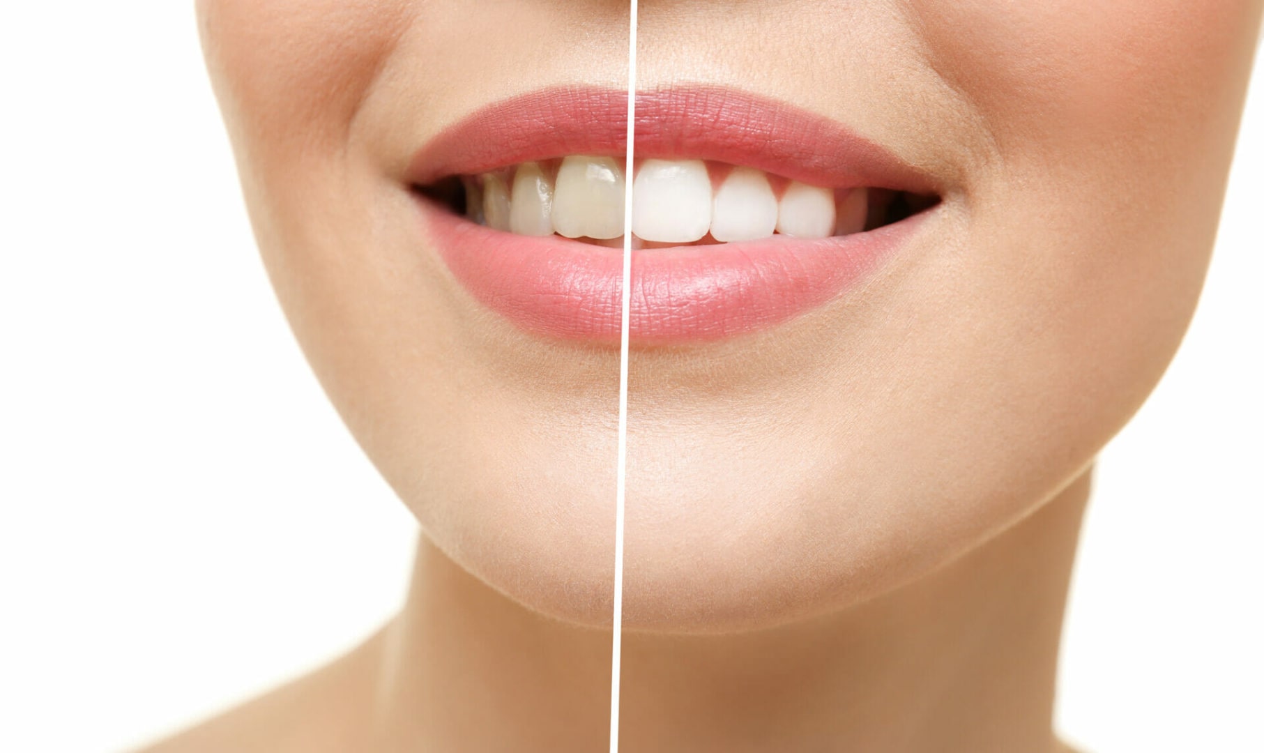 Teeth whitening Ballarat | Dental Teeth Whitening