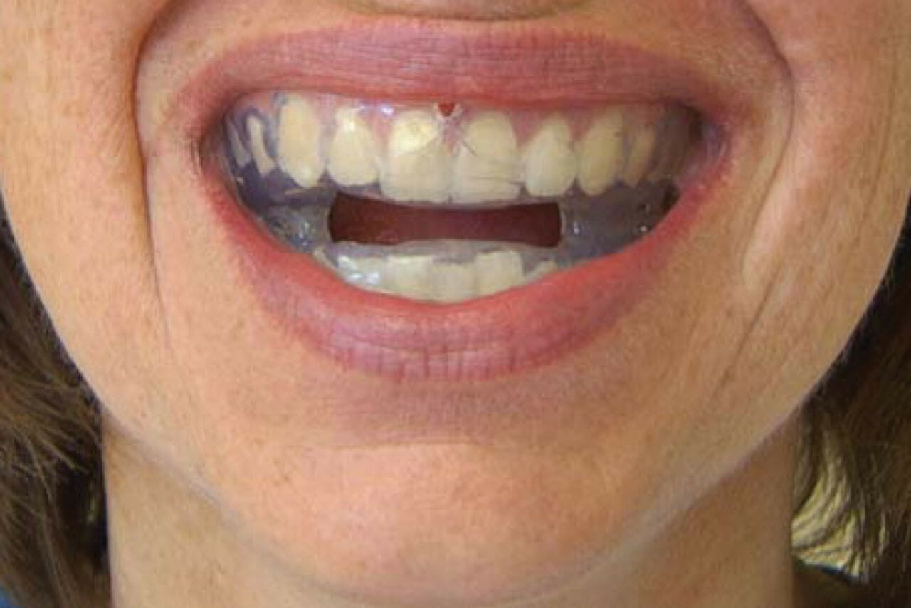 What is a Mandibular Advancement Splint?