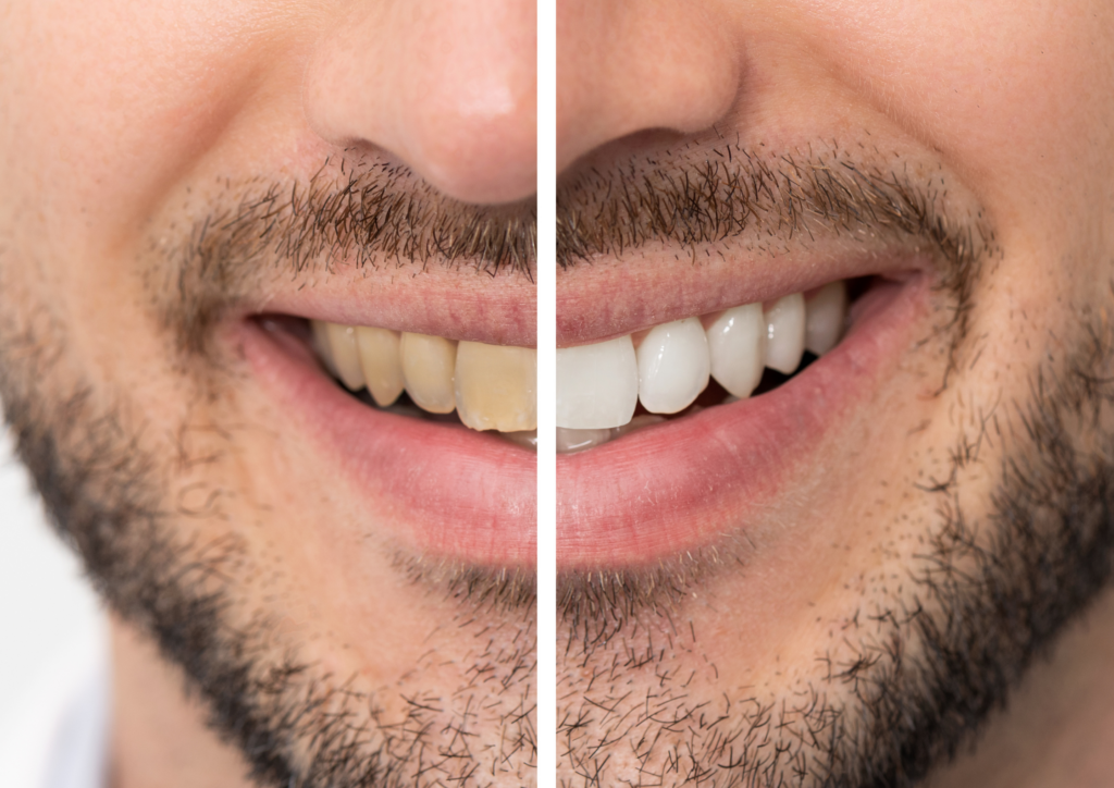 Close-up of a man's smile showing a before-and-after comparison of teeth whitening. The left side displays yellowed teeth, while the right side shows visibly whiter teeth.