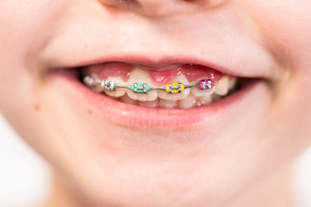 little girl with rainbow braces