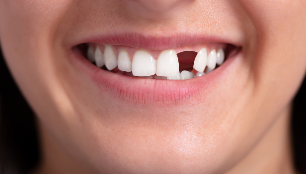 Close-up of a smile showing a missing upper front tooth and a visible gap between the teeth